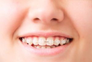 How to Care for your Teeth When Wearing Clear Braces