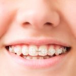 Clear Braces in Tampa, Florida