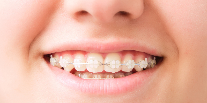 How to Care for your Teeth When Wearing Clear Braces