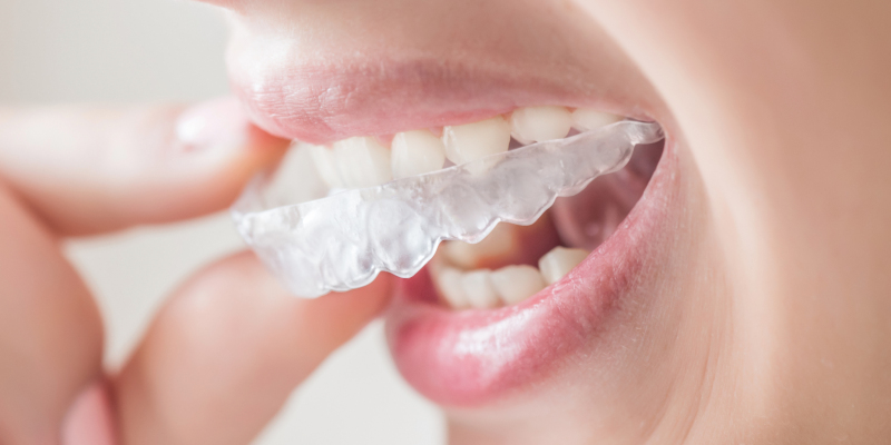 What is Invisalign 