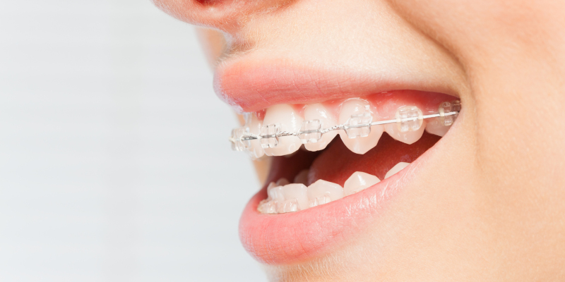 Pros and Cons of Clear Braces