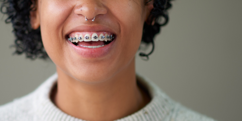 Are Metal Braces Right for You? 